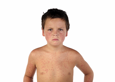 Unhappy boy with read measles spots on his face and upper body
