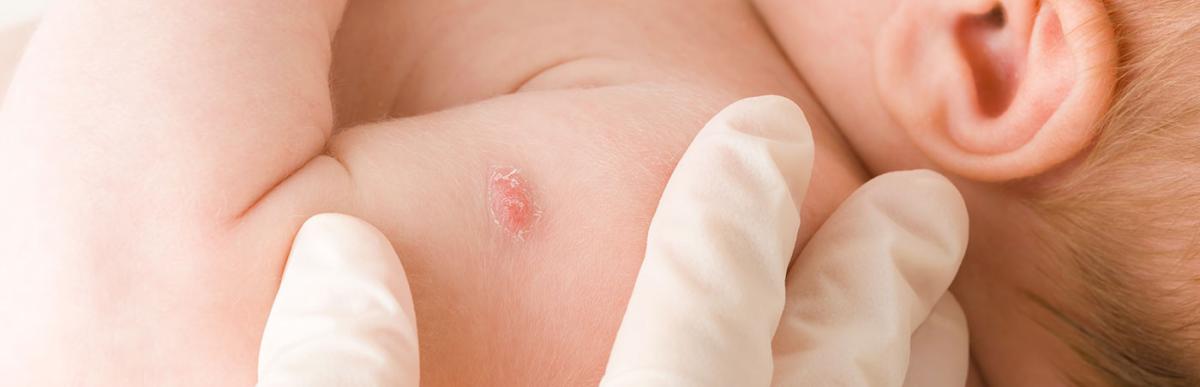 Doctor hand in white rubber protective glove showing red point after tuberculosis vaccine on newborn shoulder skin.